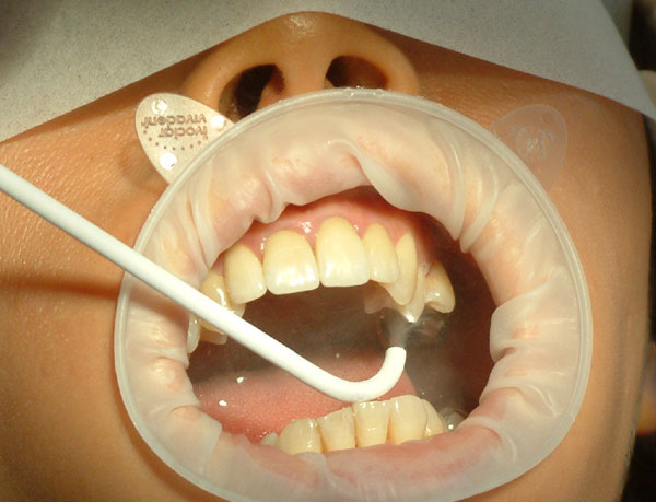 Nadwrażliwość zębiny